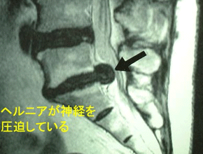 手関節の骨折