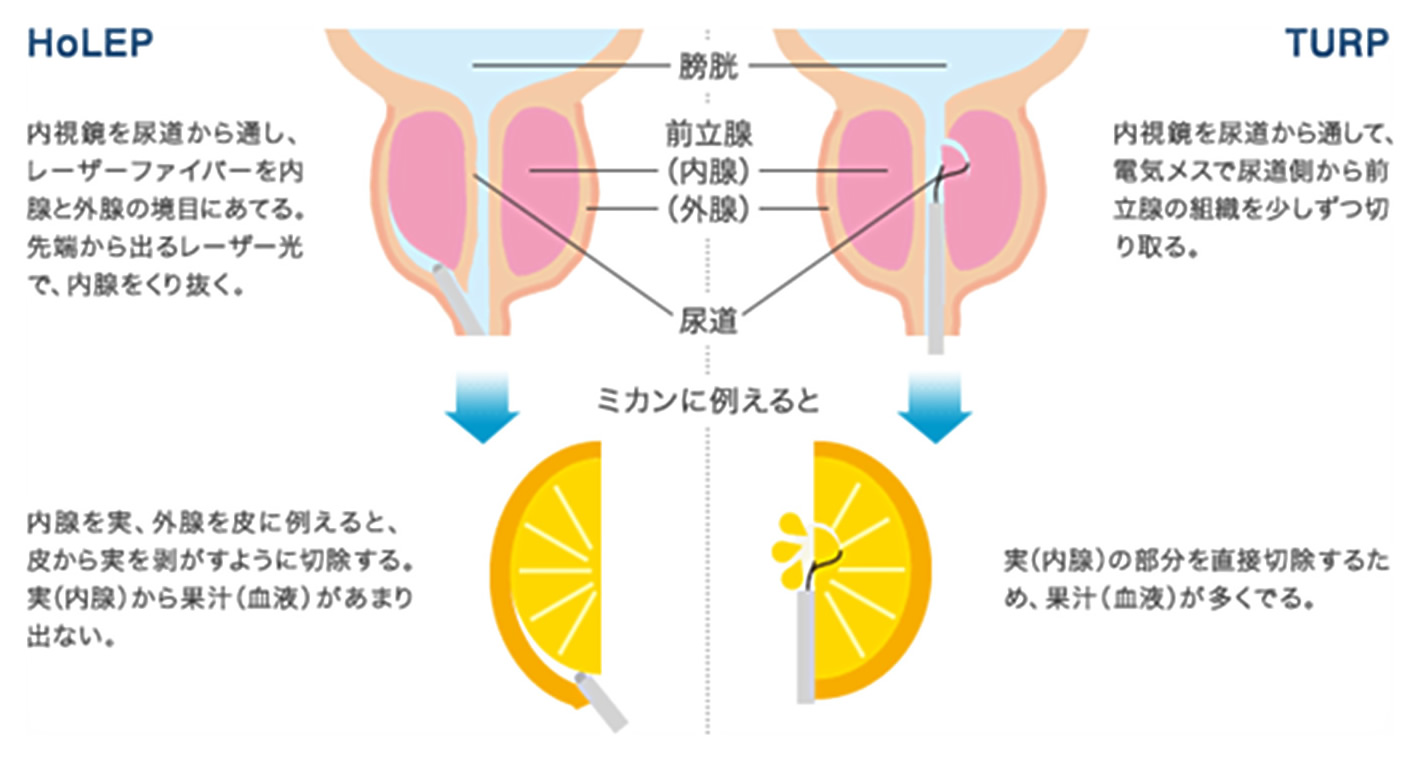 ホルミウムレーザー